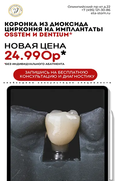 Акция Коронки на имплантаты